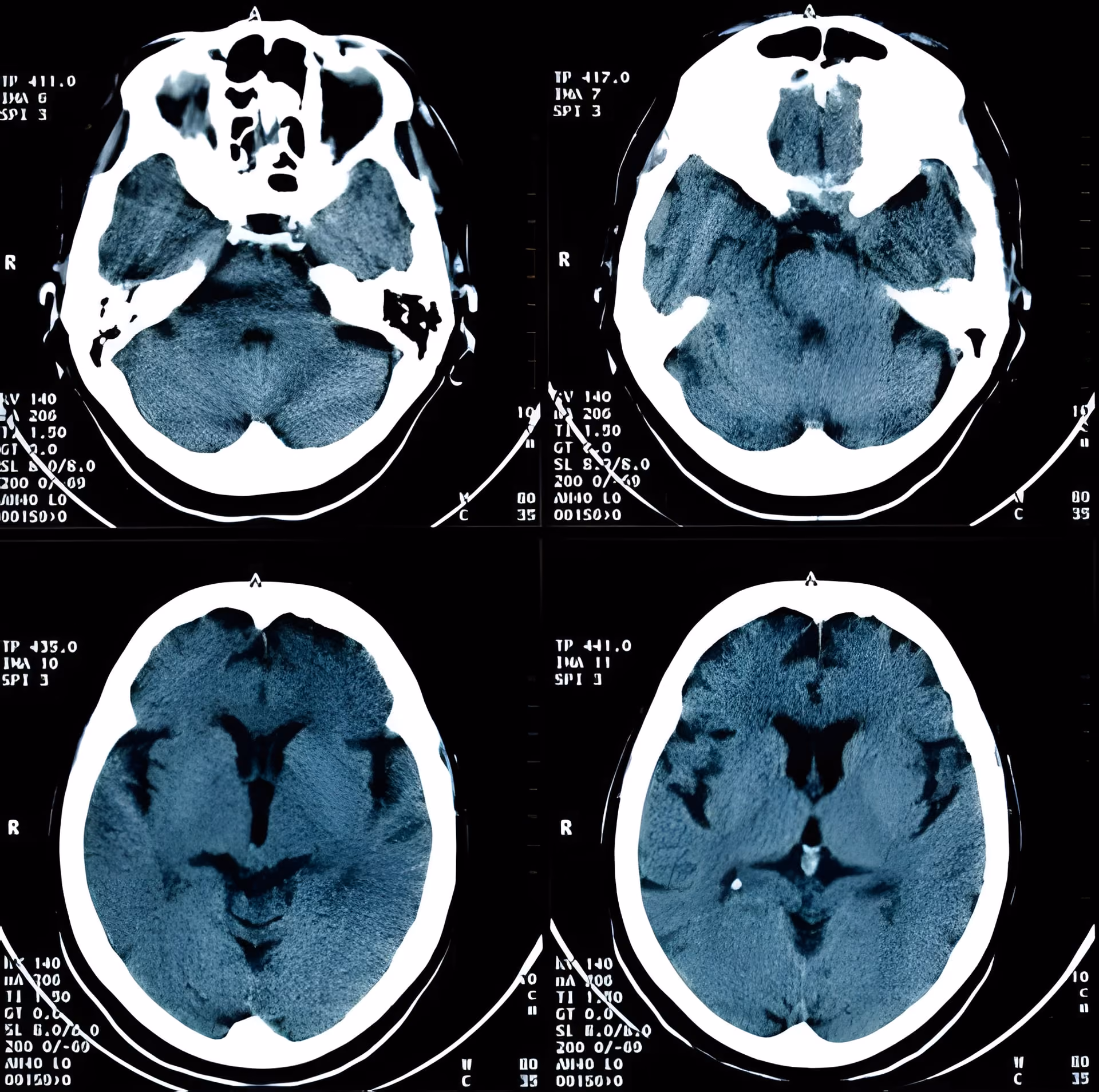 Suspect Alzheimer’s? Tips and tests for detection
